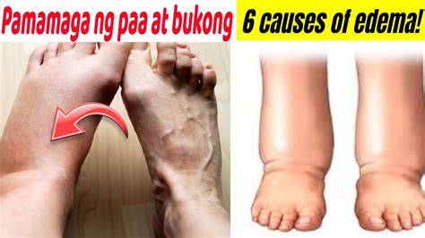 pamamaga ng paa in english|Pagmamanas .